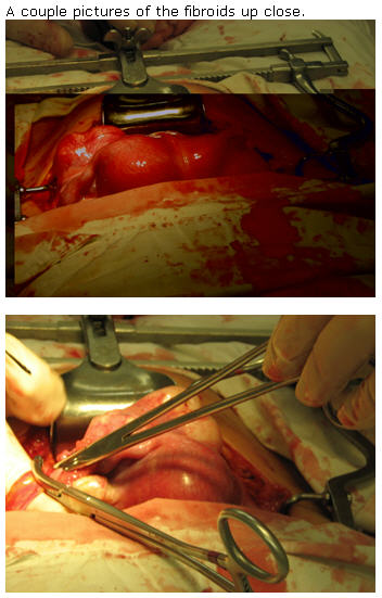 fibroids-2.jpg