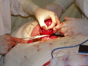 The thyroid mass fills Jane's hand