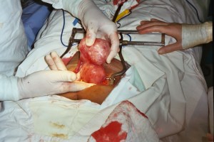 surgery-fibroid1 An unusual fibroid position on top of the uterus