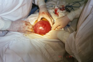 The large soft fibroid that caused some tachycardia for us.
