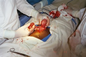 Another case with an unusual fibroid off the top of the uterus and a large cyst involving the right tube.