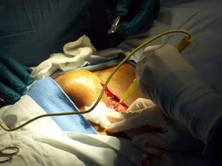 Making the initial incision