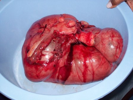 The entire mass was removed.