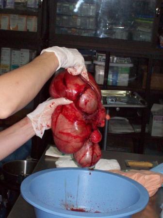 Jane is inspecting the fibroid mass.