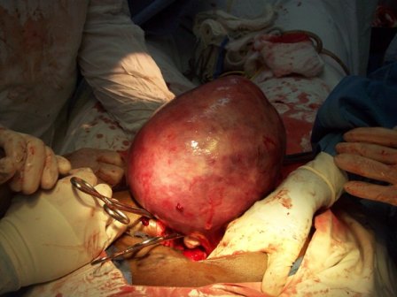 The other hysterectomy involving very large fibroids.