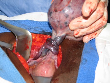 Twisted cyst of left ovary with infarction of ovary